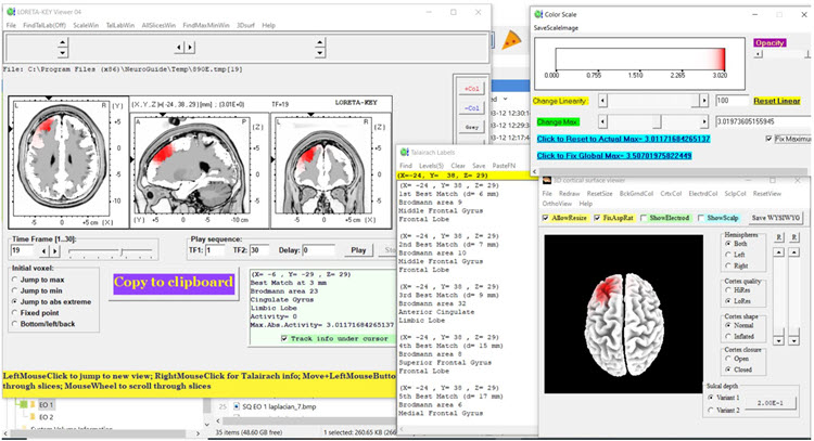 Figure 20 - Post-neurofeedback eyes-closed z-score LORETA analysis for 19 Hz